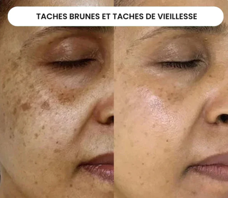 Micro-Infusion Lift Verelyss