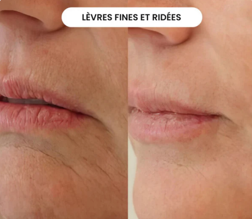 Micro-Infusion Lift Verelyss