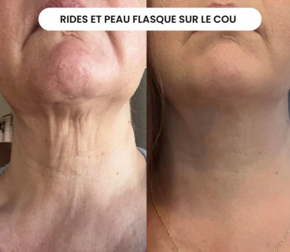 Micro-Infusion Lift Verelyss